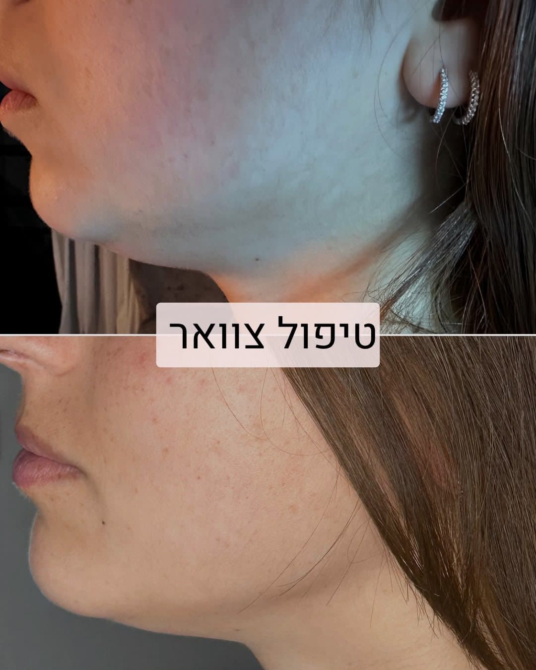 לפני ואחרי טיפול מיצוק צוואר בקליניקה של חן זך באבן יהודה